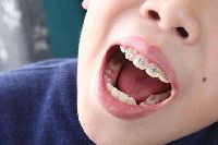 【健康解碼】矯正牙齒真的可以瘦臉嗎？